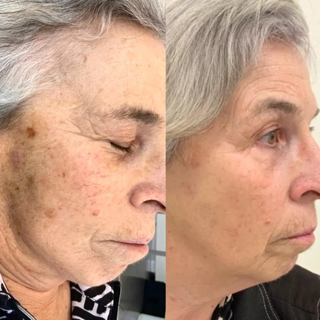 Fotona Spider Vein Treatment — Nu Image Medical Esthetics